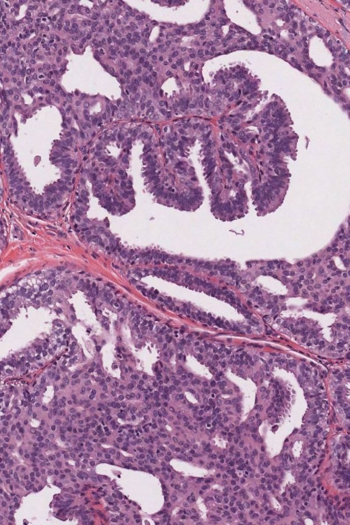 Sinonazal Papillomlar